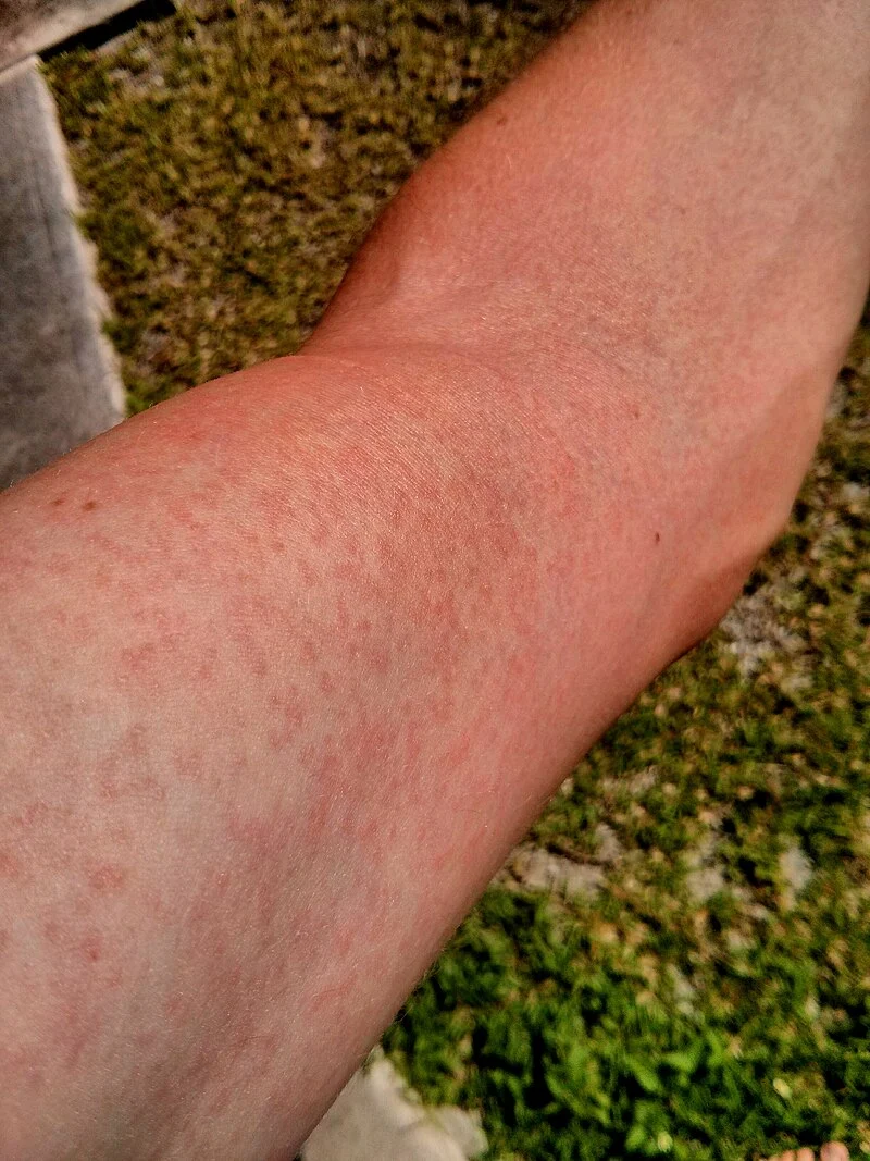 Zika.Virus_.Rash_.Arm